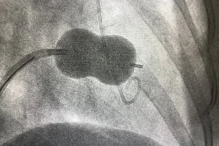 Baloon Valvuloplasty